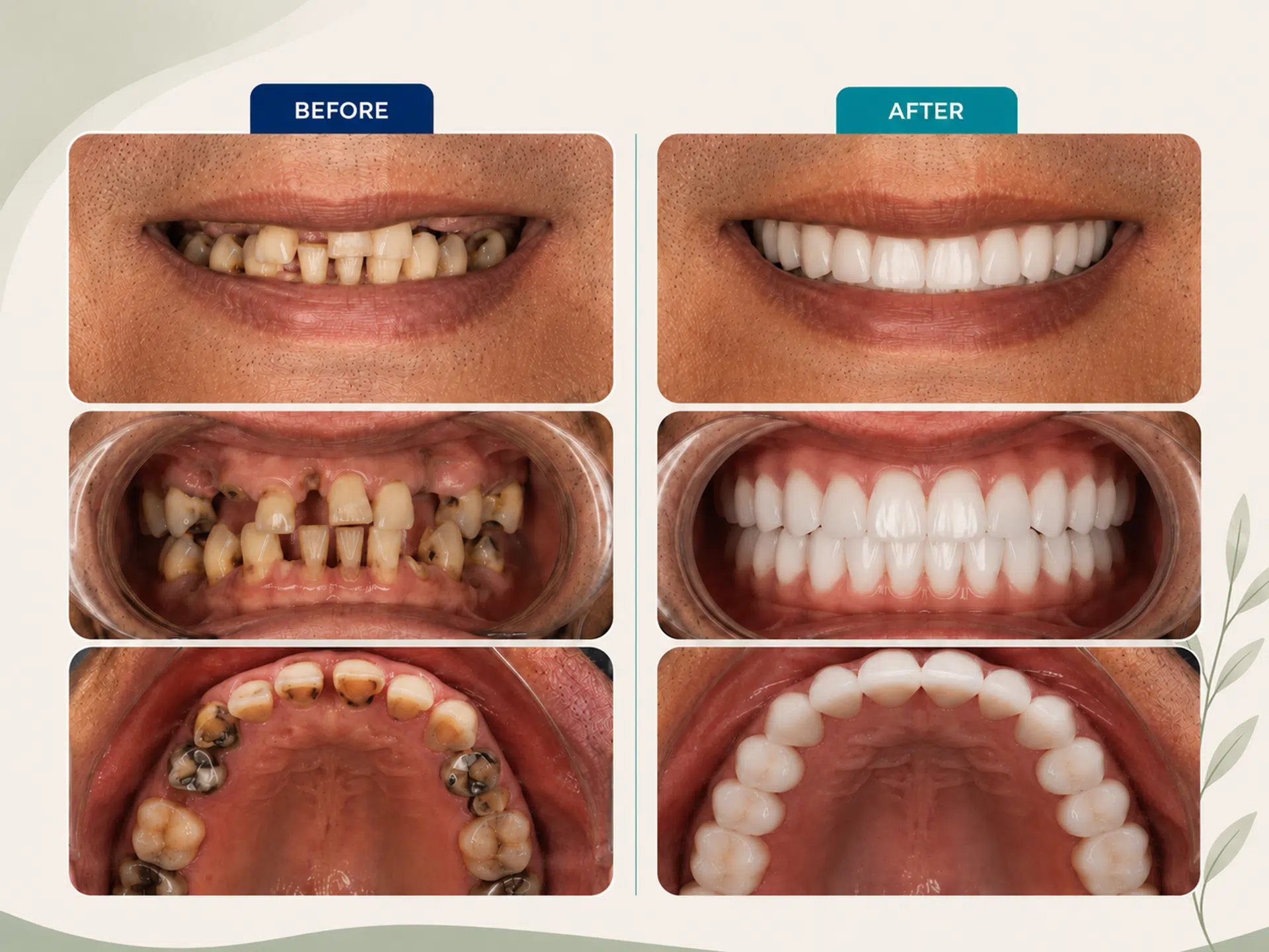 Full Mouth Rehabilitation