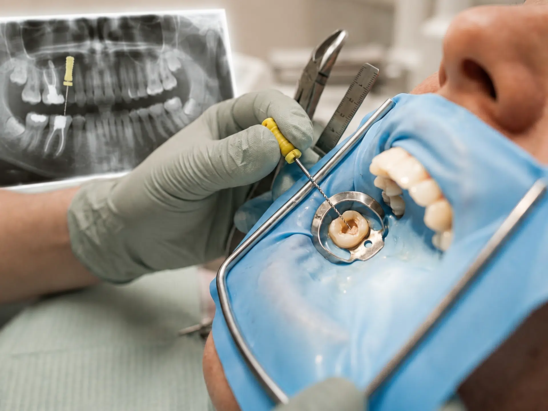 Root Canal Treatments