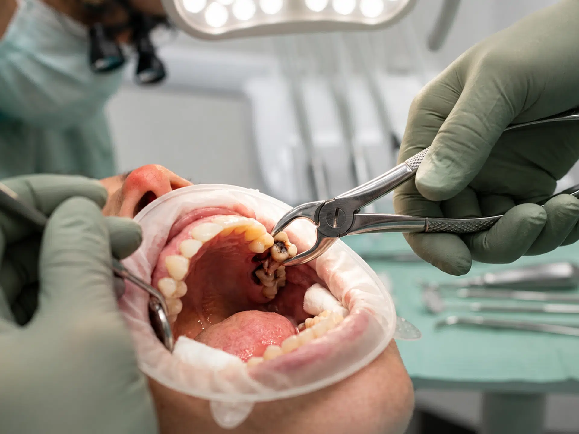Tooth Extraction