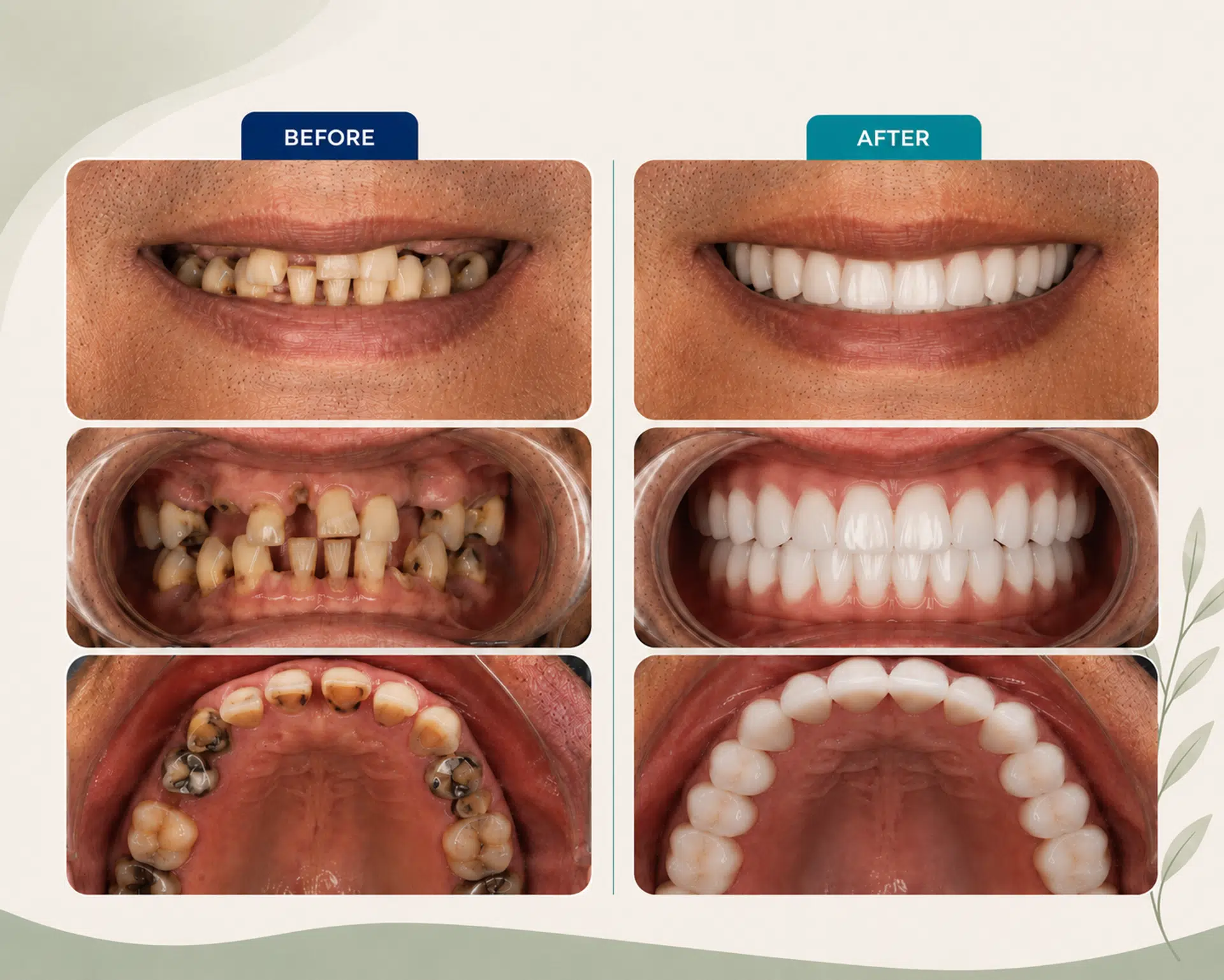 Full Mouth Rehabilitation
