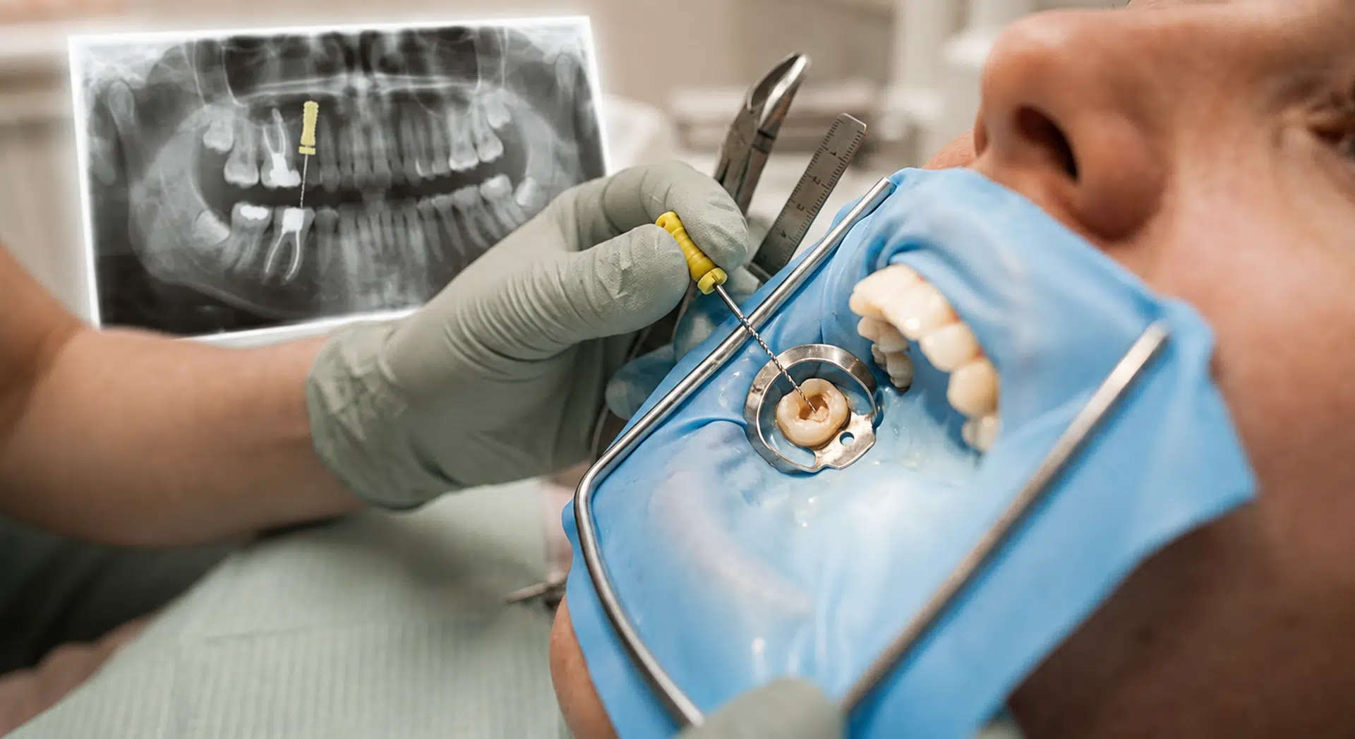 Root Canal Treatments