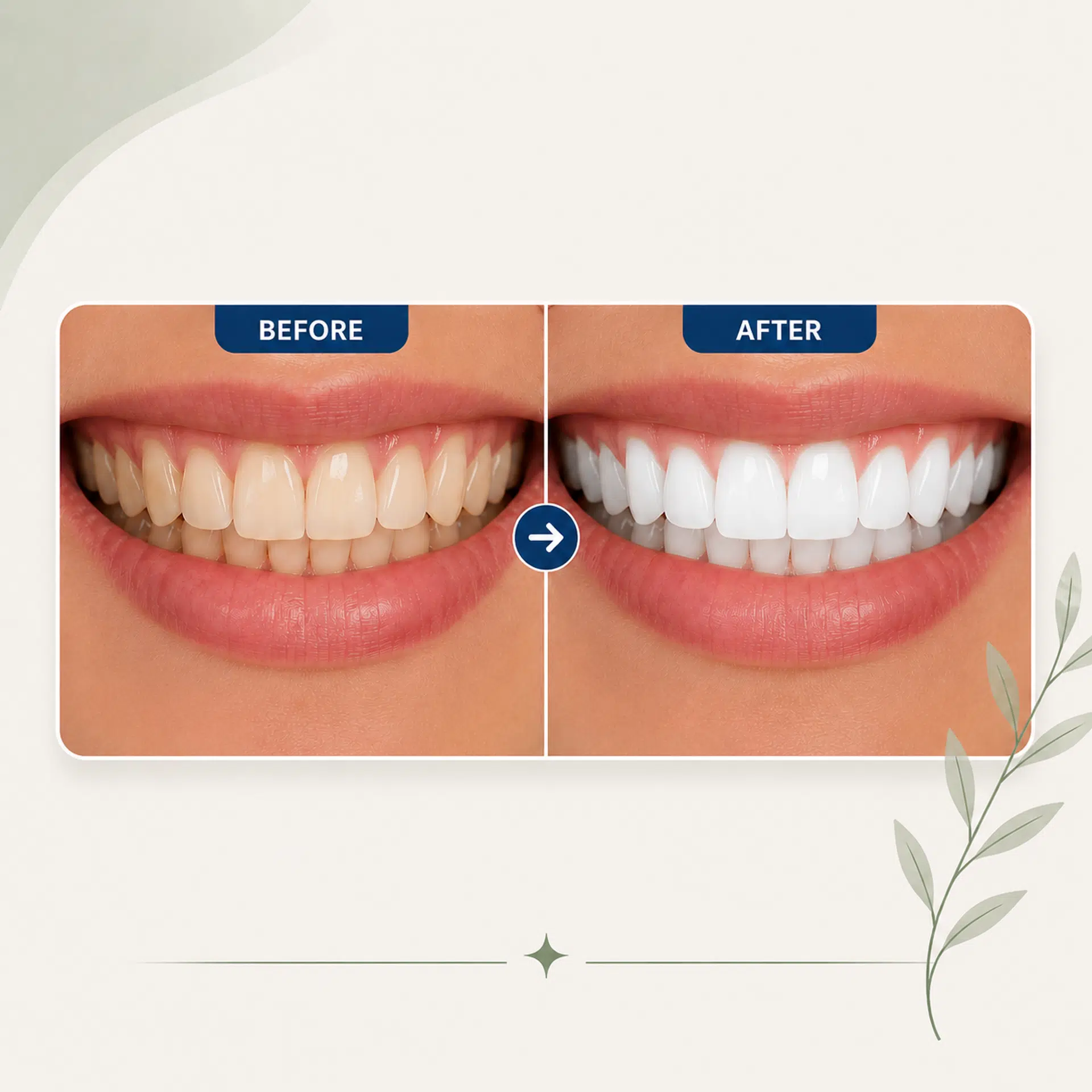 Teeth Whitening