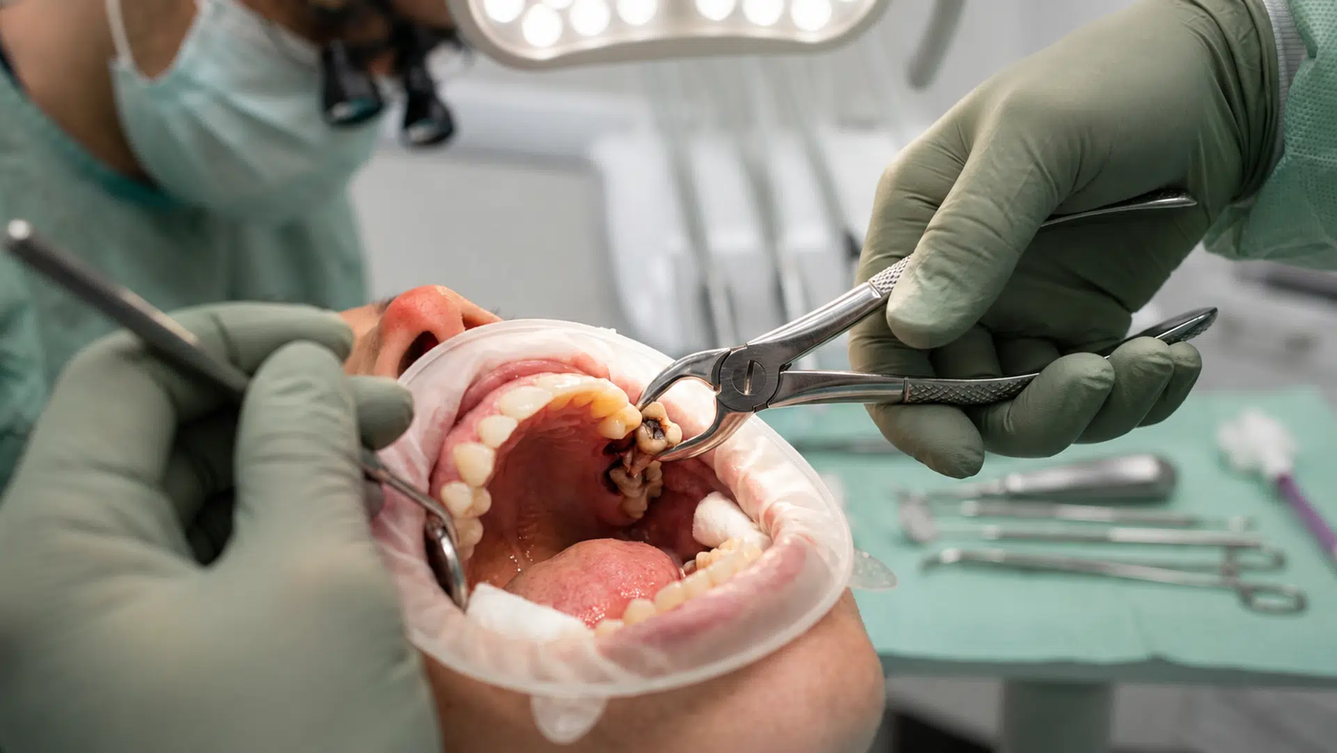 Tooth Extraction